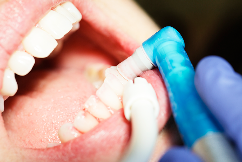 予防・クリーニング